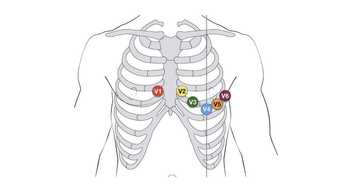 Step by Step Guide to ECG Leads Placement
