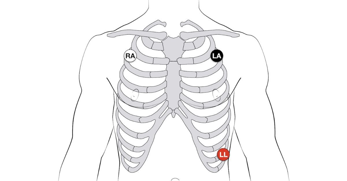 best-practices-for-ecg-lead-placement
