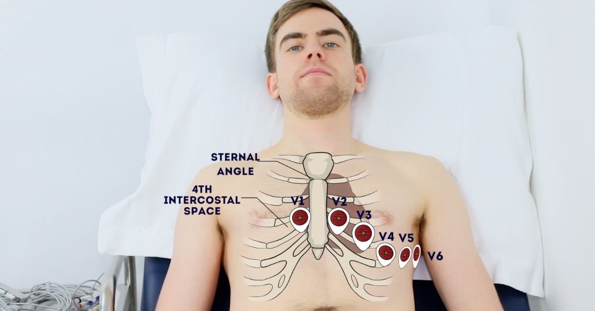 common-ecg-lead-placement-mistakes-and-how-to-avoid-them