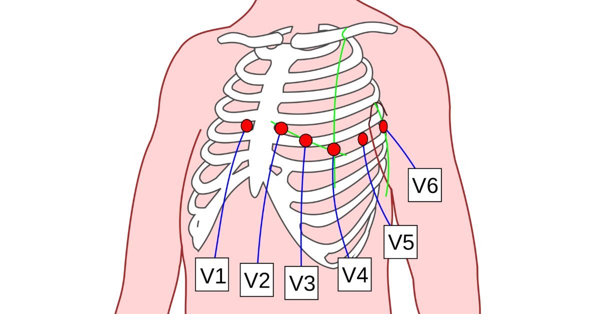 precordial-chest-leads-placement-v1-v6