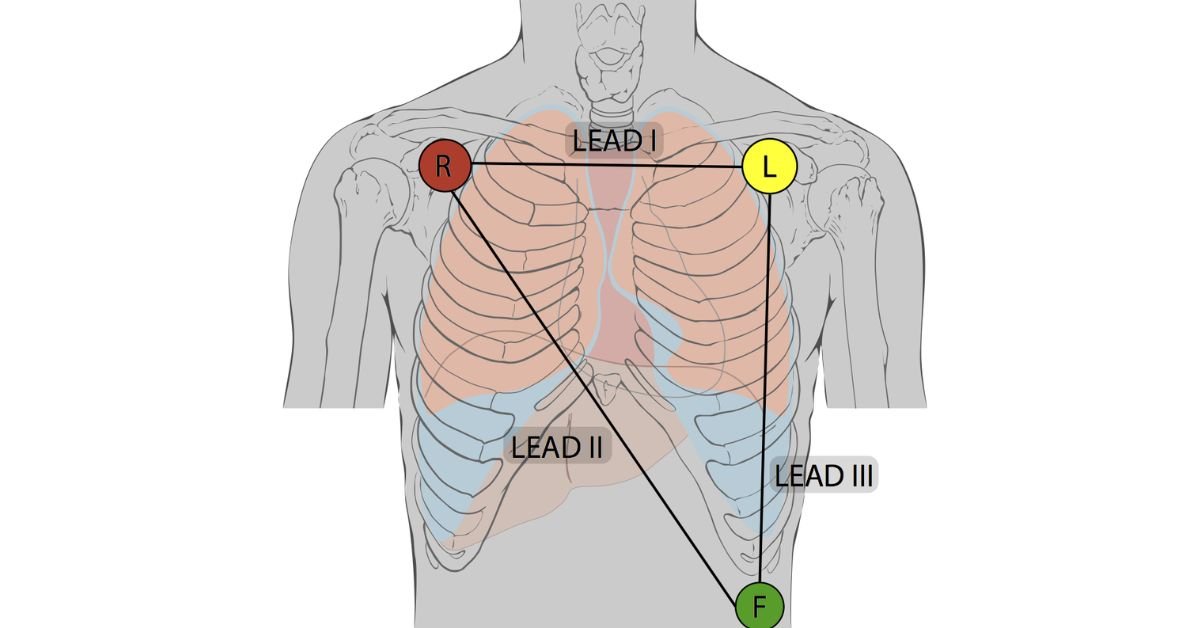 special-lead-placements-additional-configurations