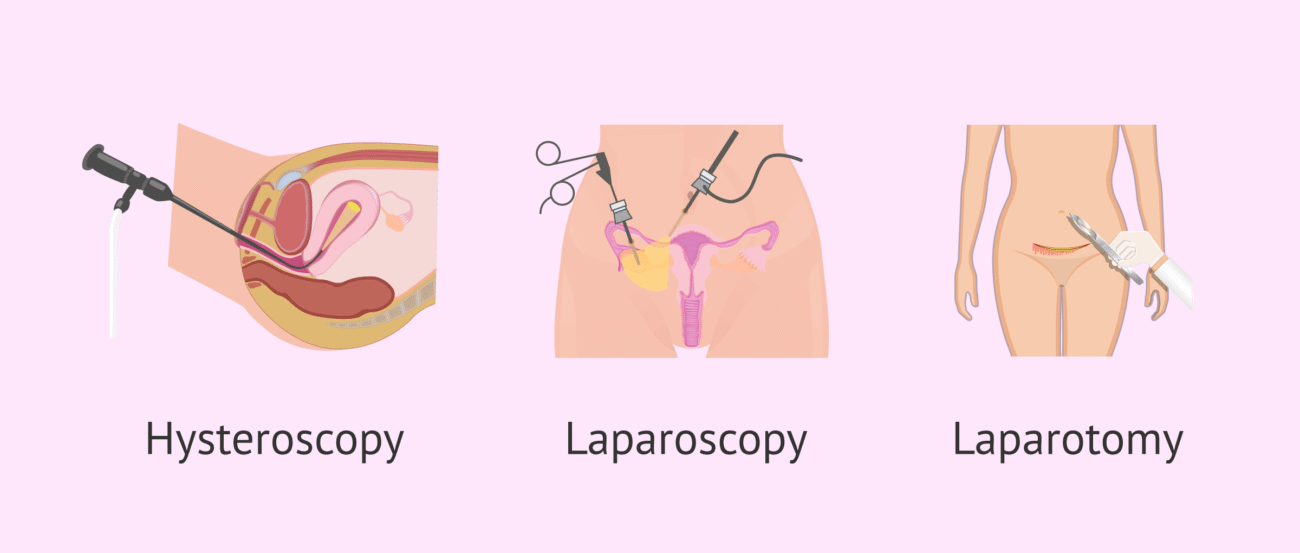 Laparotomy vs Laparoscopy