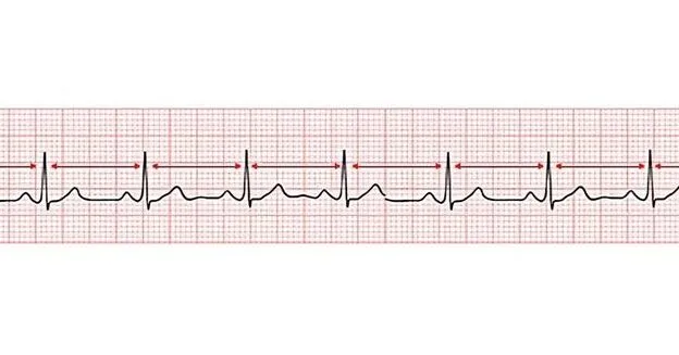 interpreting-ecg-results