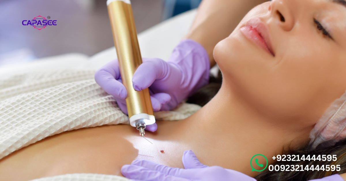 aftercare-and-alternatives-maximizing-effectiveness-in-wart-treatment-at-capasee
