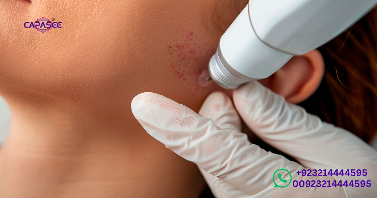 aftercare-and-recovery-minimizing-risks-of-electrocautery-wart-removal