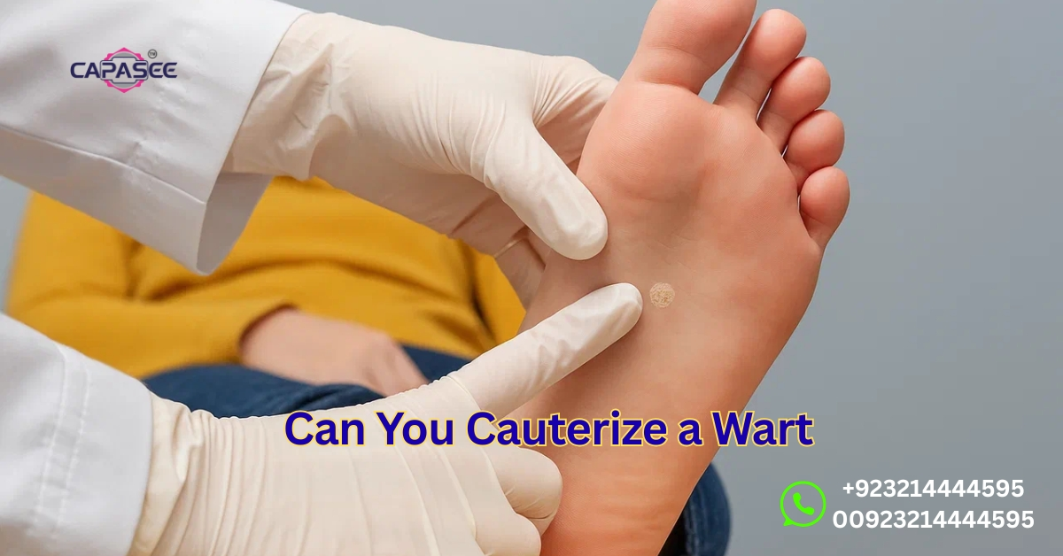 Can You Cauterize a Wart