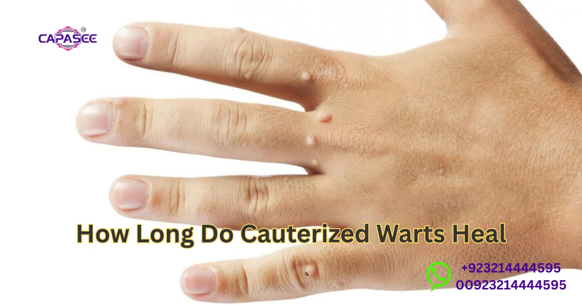 Cauterized warts