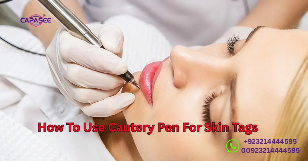 Cautery Pen For Skin Tags