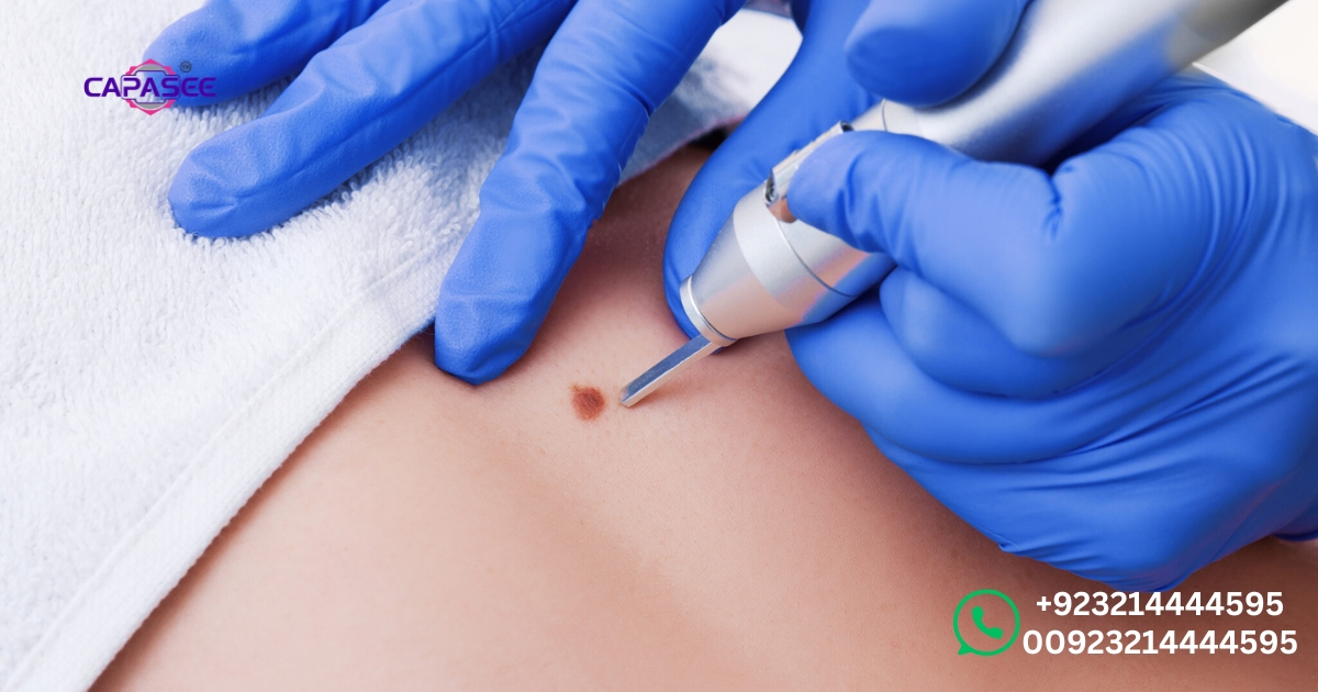 comprehensive-skin-lesion-removal-methods-and-cautery-treatments-at-capasee