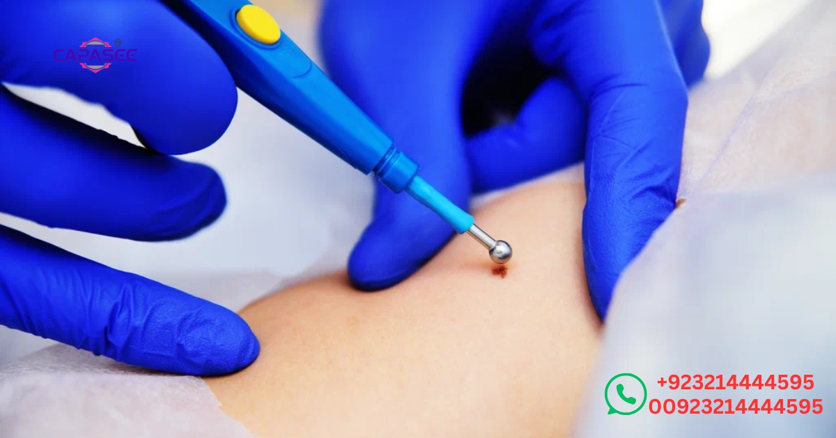 cost-availability-and-best-practices-for-cautery-pen-skin-tag-removal-in-pakistan