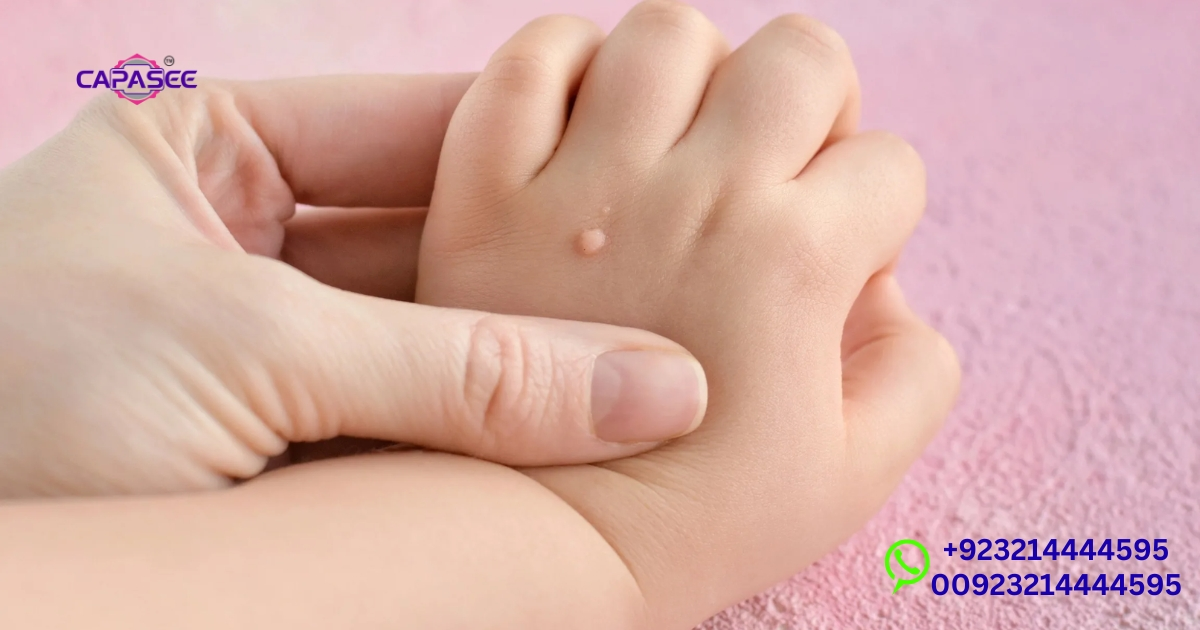 essential-wart-removal-aftercare-instructions-from-capasee