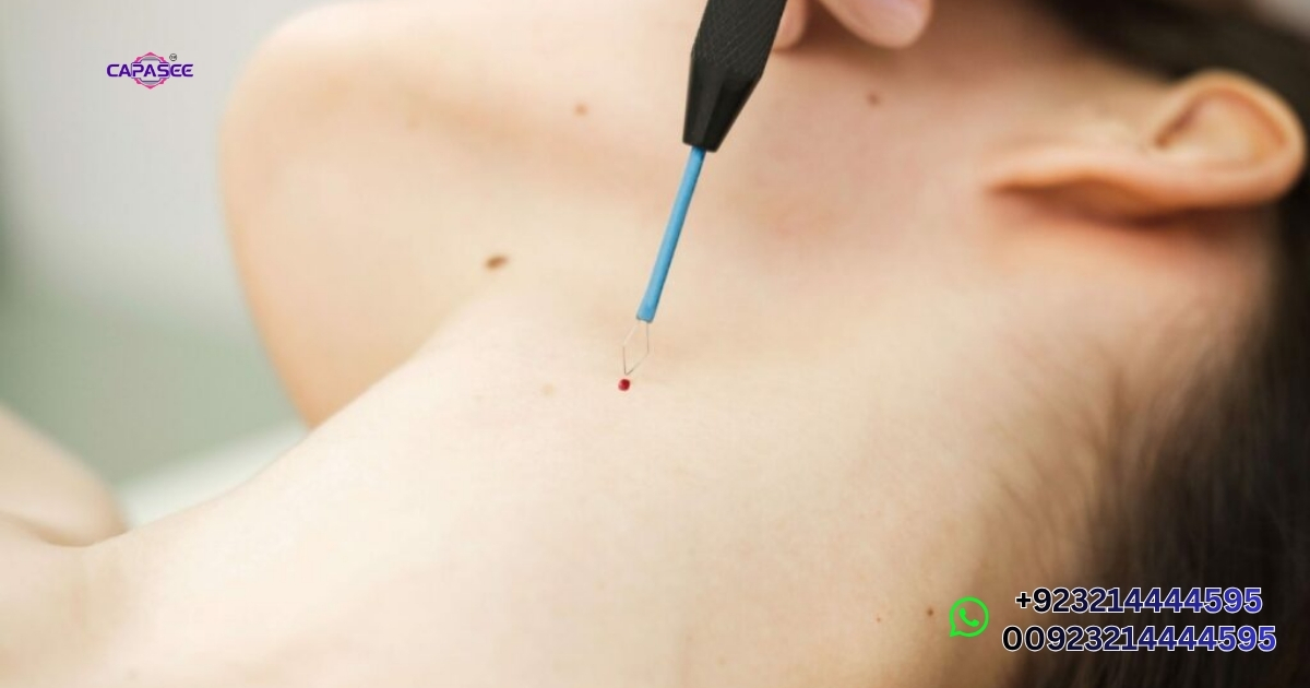 is a cautery pen safe for skin tag removal at home?