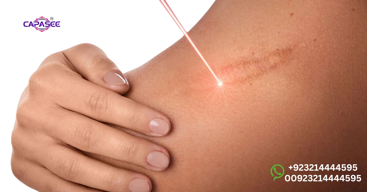 managing-skin-scab-healing-and-burn-recovery-after-cauterization-with-capasee