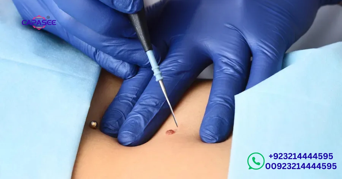 medical-cauterization-procedure-explained-by-capasee-electro-medical-engineering