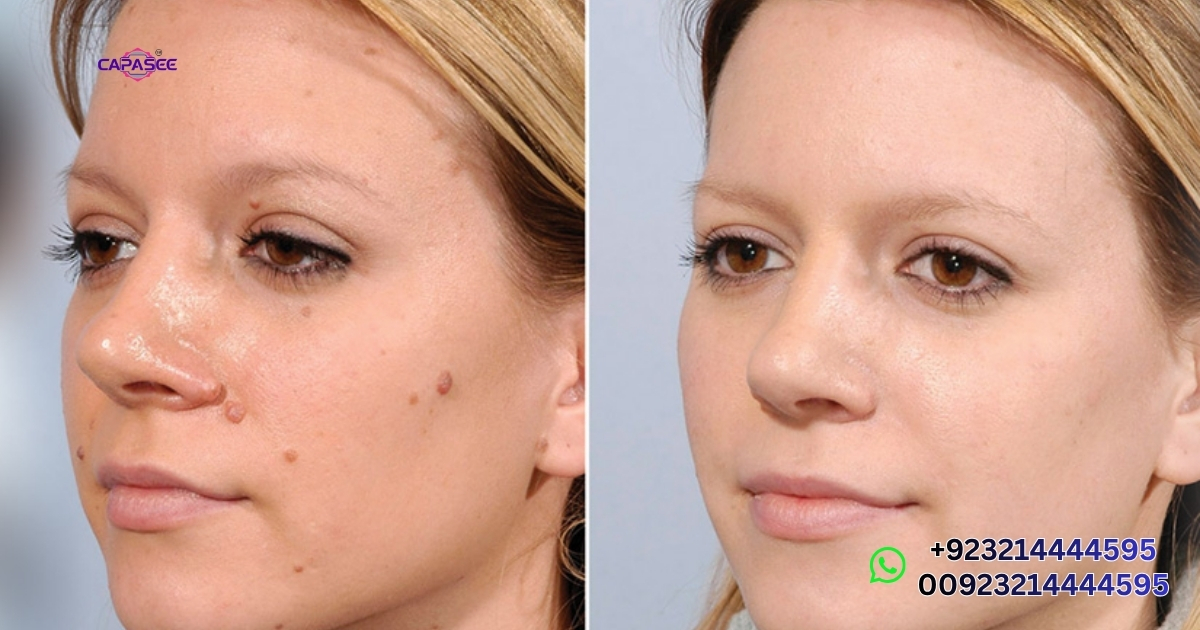 skin tag removal results, aftercare, and common problems