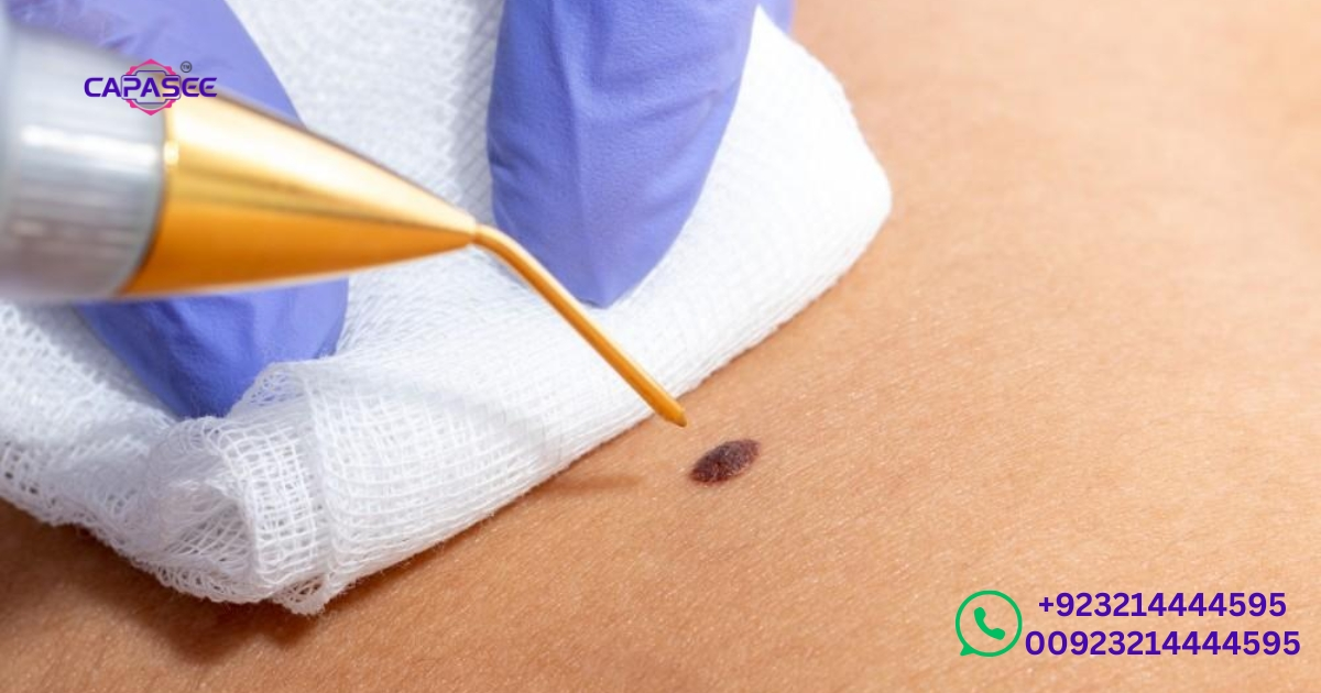 wart-cauterization-procedures-by-capasee-electro-medical-engineering