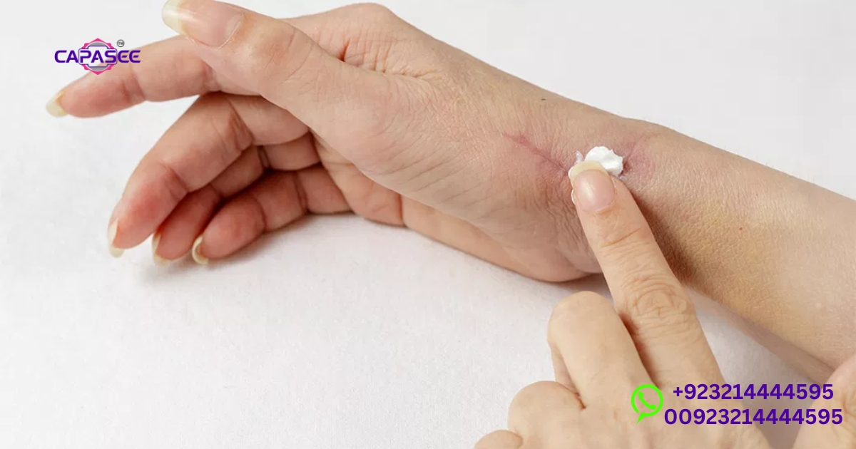 advanced-healing-and-scar-treatment-options-for-cauterized-wounds-by-capasee