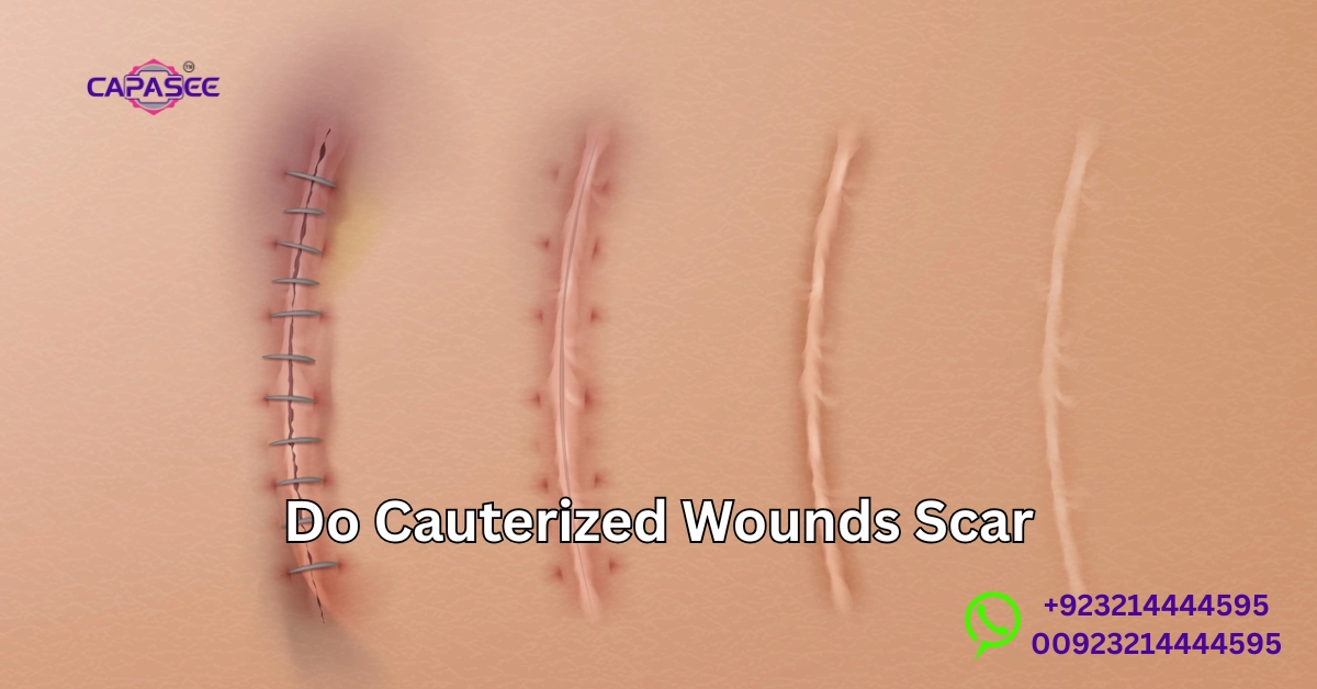 Cauterized wounds scar