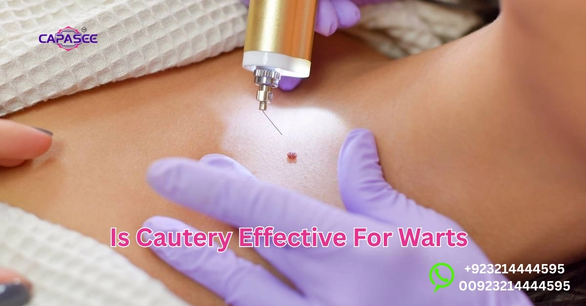 Cautery Effective For Warts