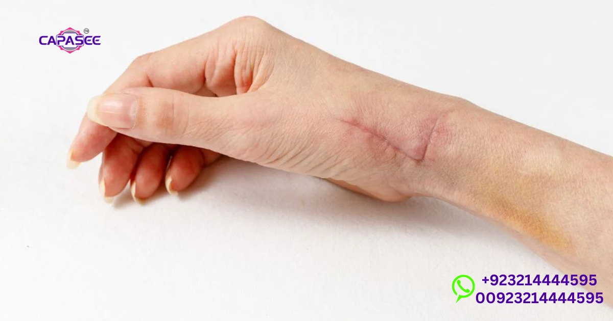 proven-strategies-for-cautery-wound-scar-prevention-and-treatment-by-capasee
