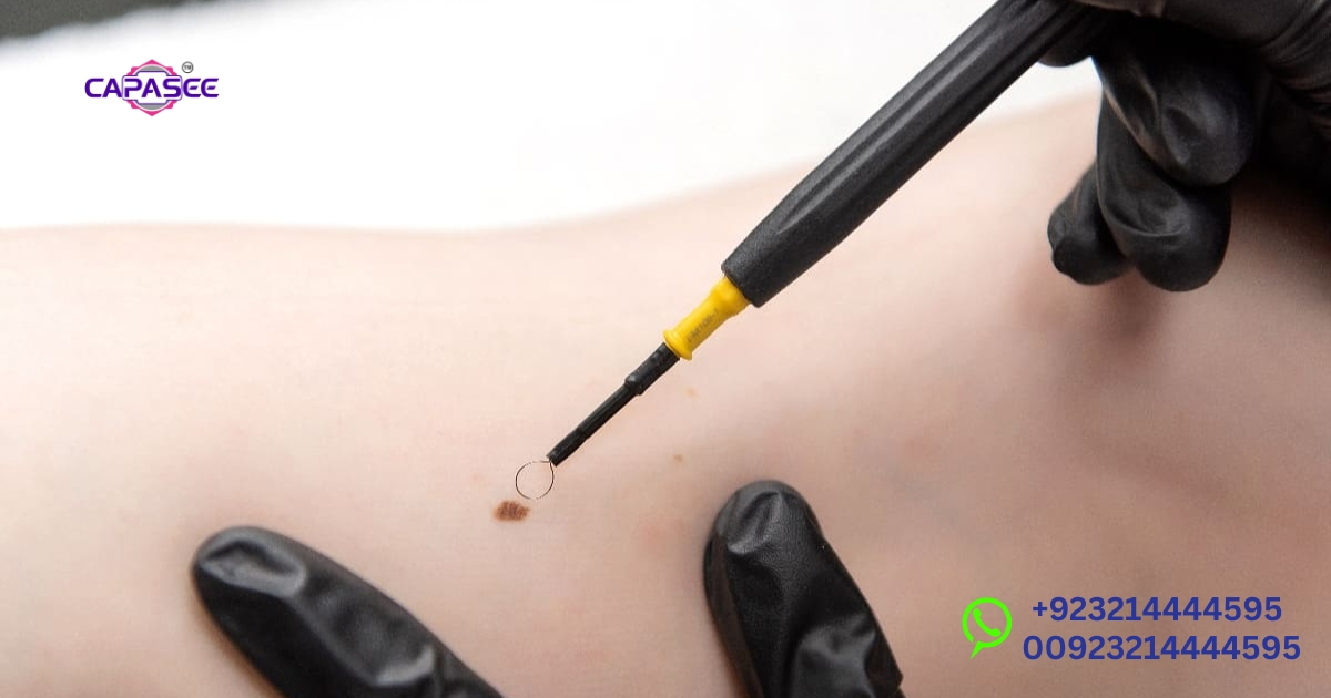 surgical-risks-and-complications-of-monopolar-cautery-with-capasee