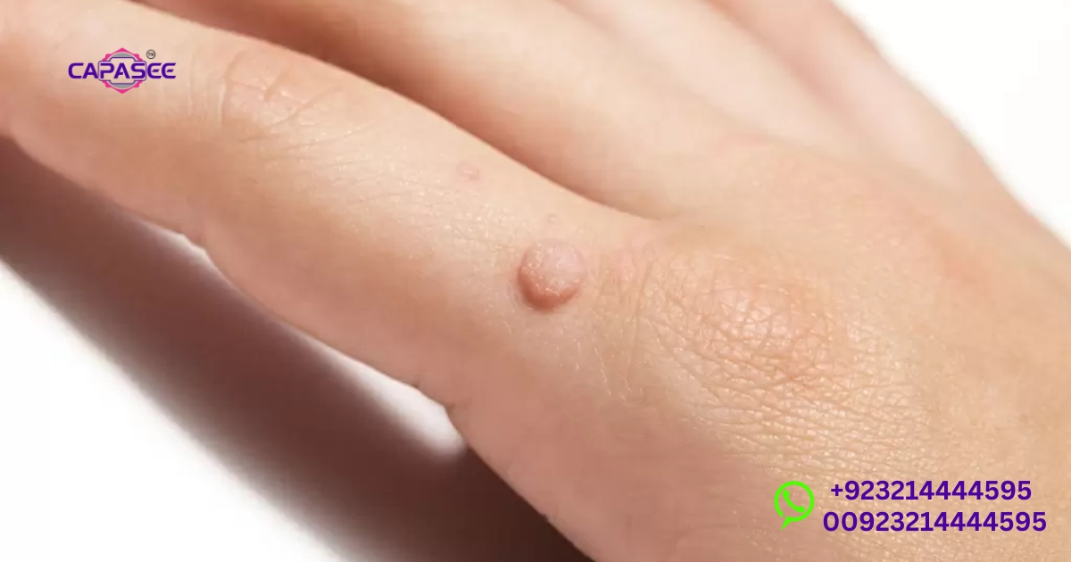 Advanced Medical Treatments for Wart Removal
