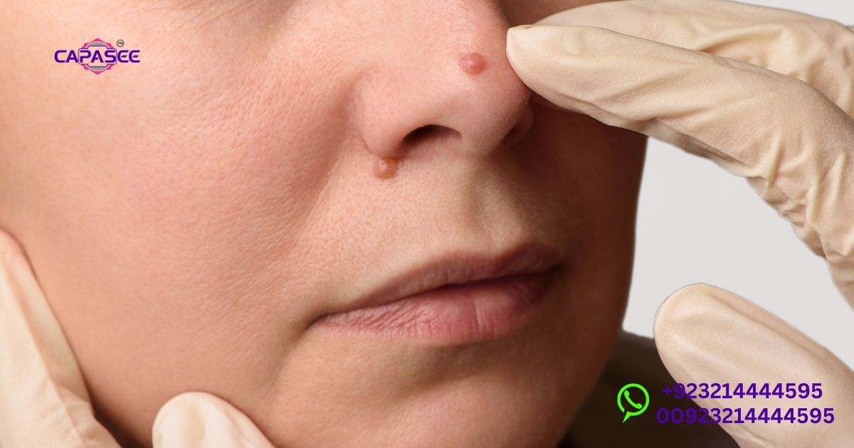 Choosing the Right Wart Removal Treatment in Pakistan