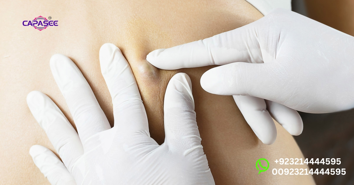 Cost of Cautery Treatment for Warts