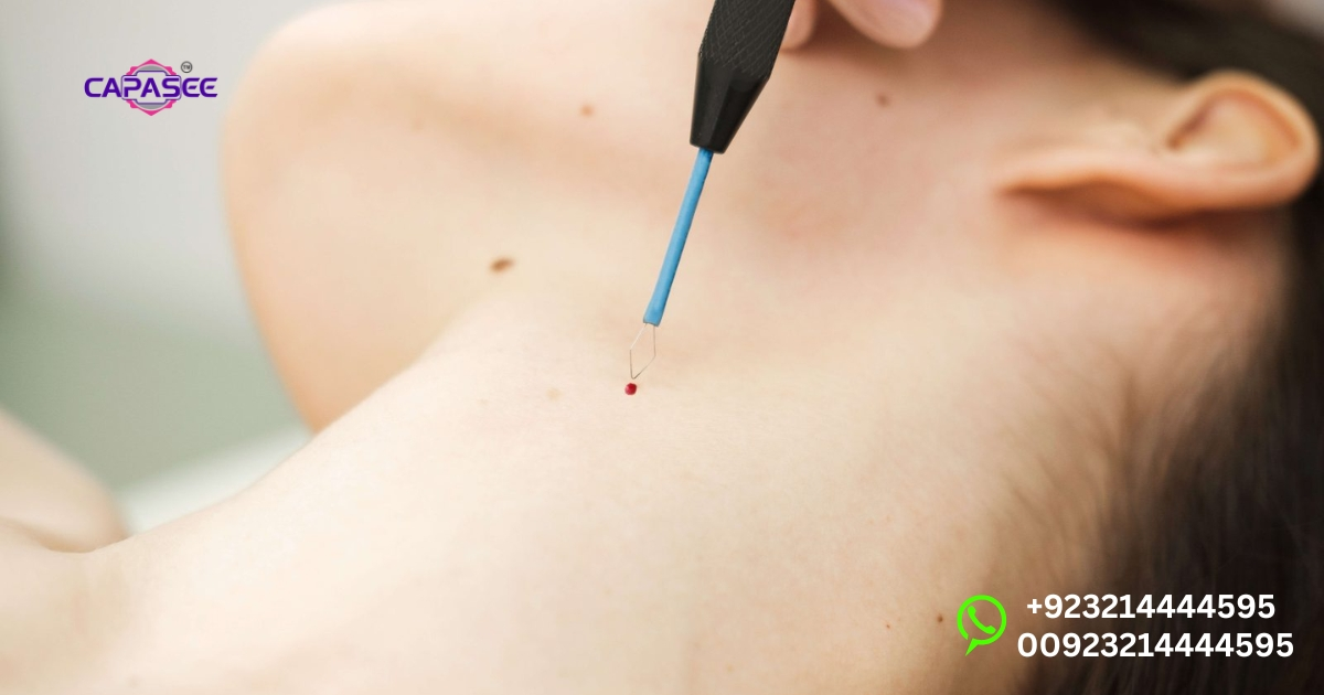 Effective Wart Removal with Capasee