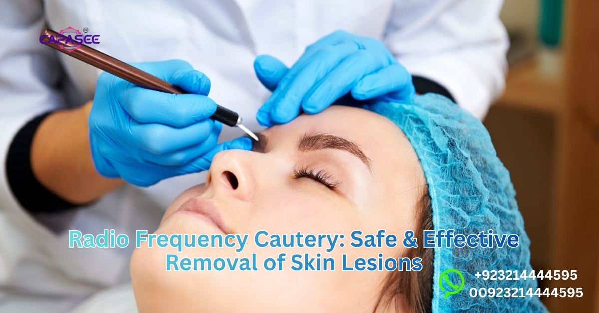 Radio Frequency Cautery