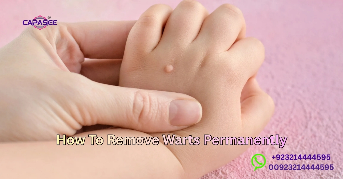 Remove Warts Permanently