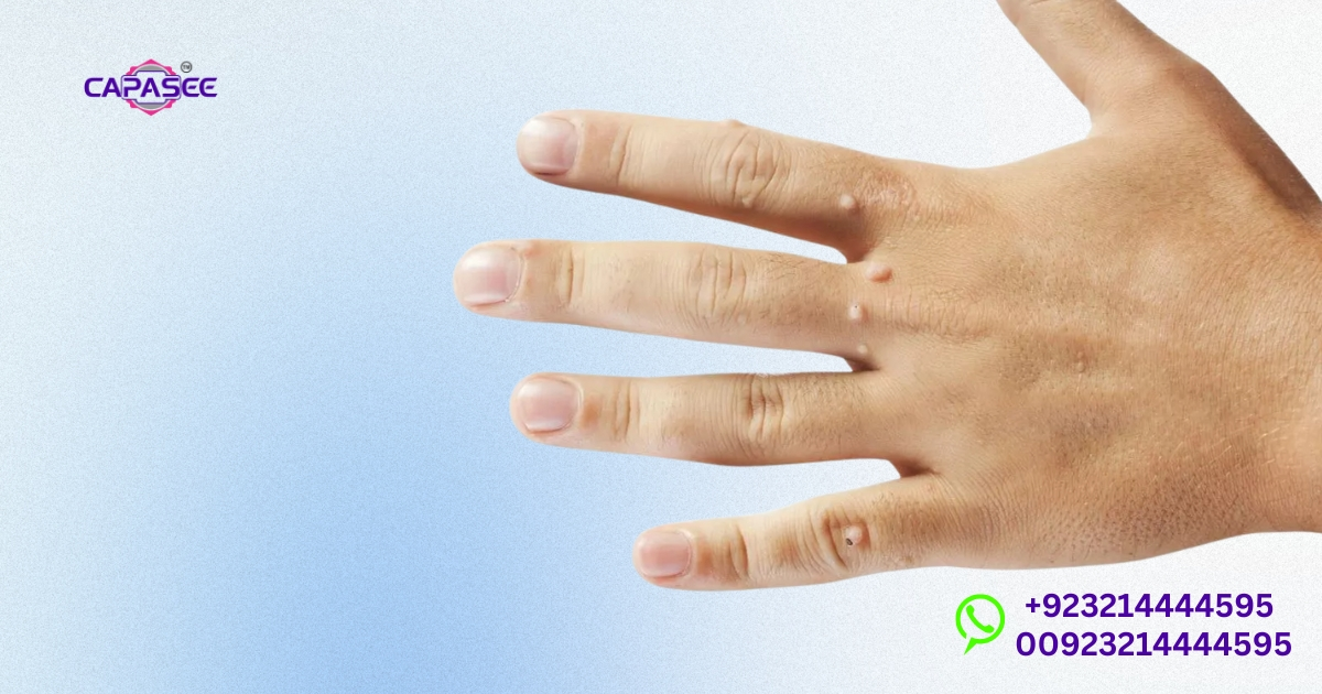 Wart Removal Pain Level in Pakistan