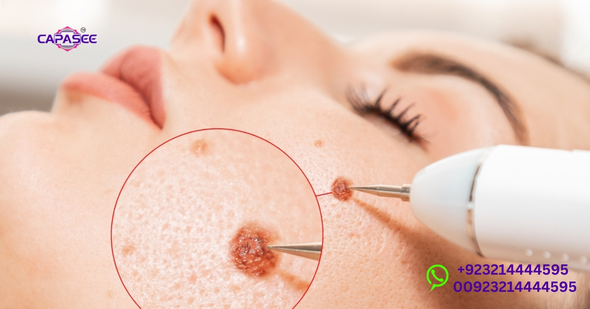 Wart Treatment Options in Pakistan