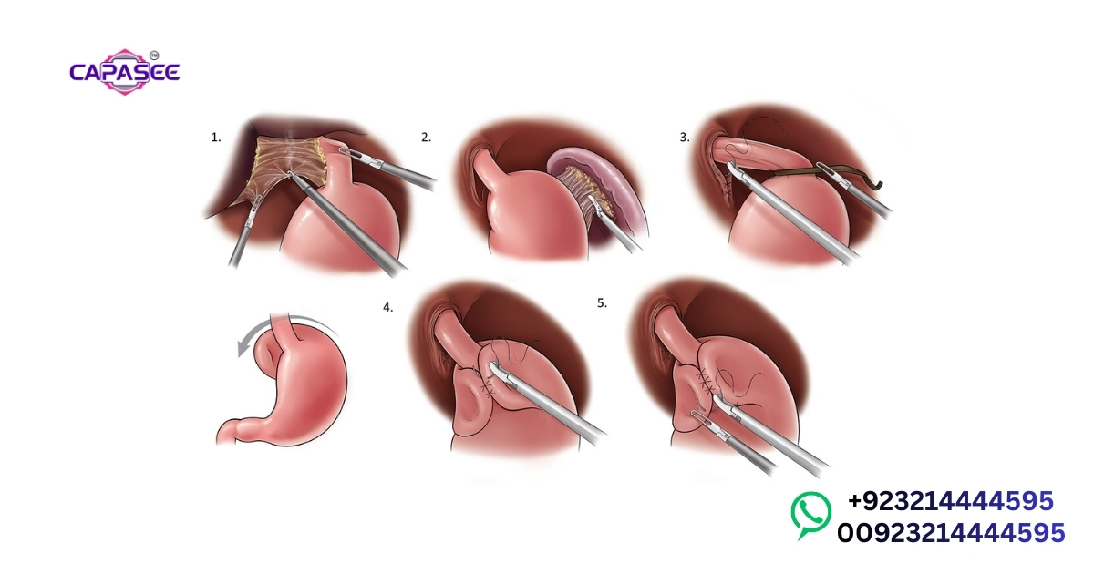 Fundoplication Cost Pakistan Breakdown