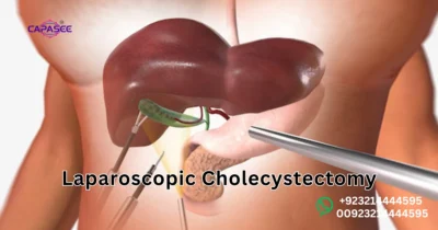 Laparoscopic Cholecystectomy