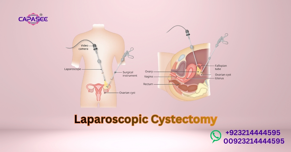 Laparoscopic Cystectomy