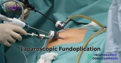 Laparoscopic Fundoplication