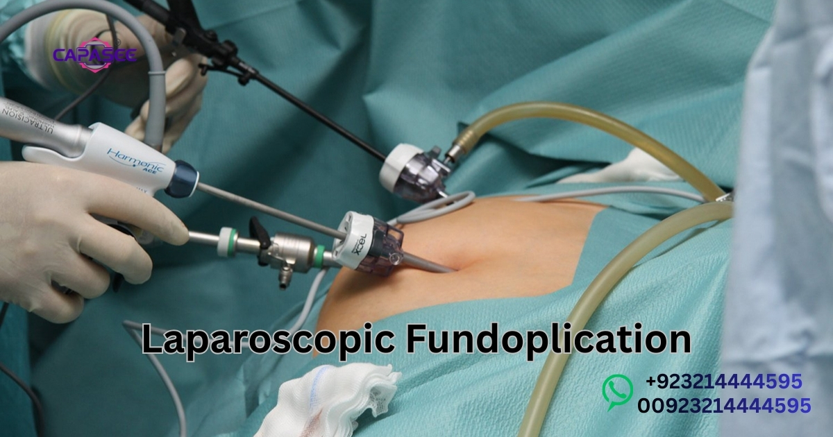 Laparoscopic Fundoplication