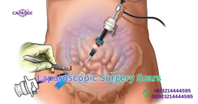Laparoscopic Surgery Scars