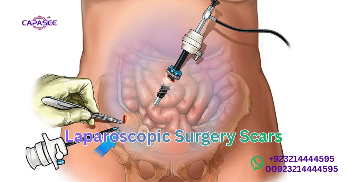 Laparoscopic Surgery Scars