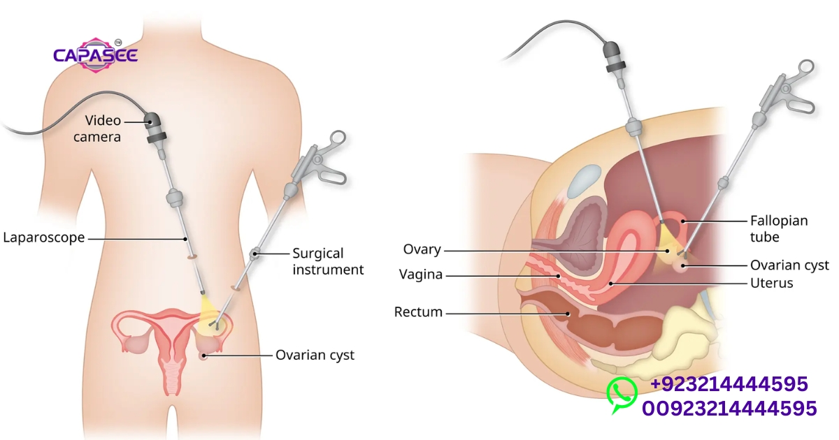 Laparoscopic Varicocele Treatment Options