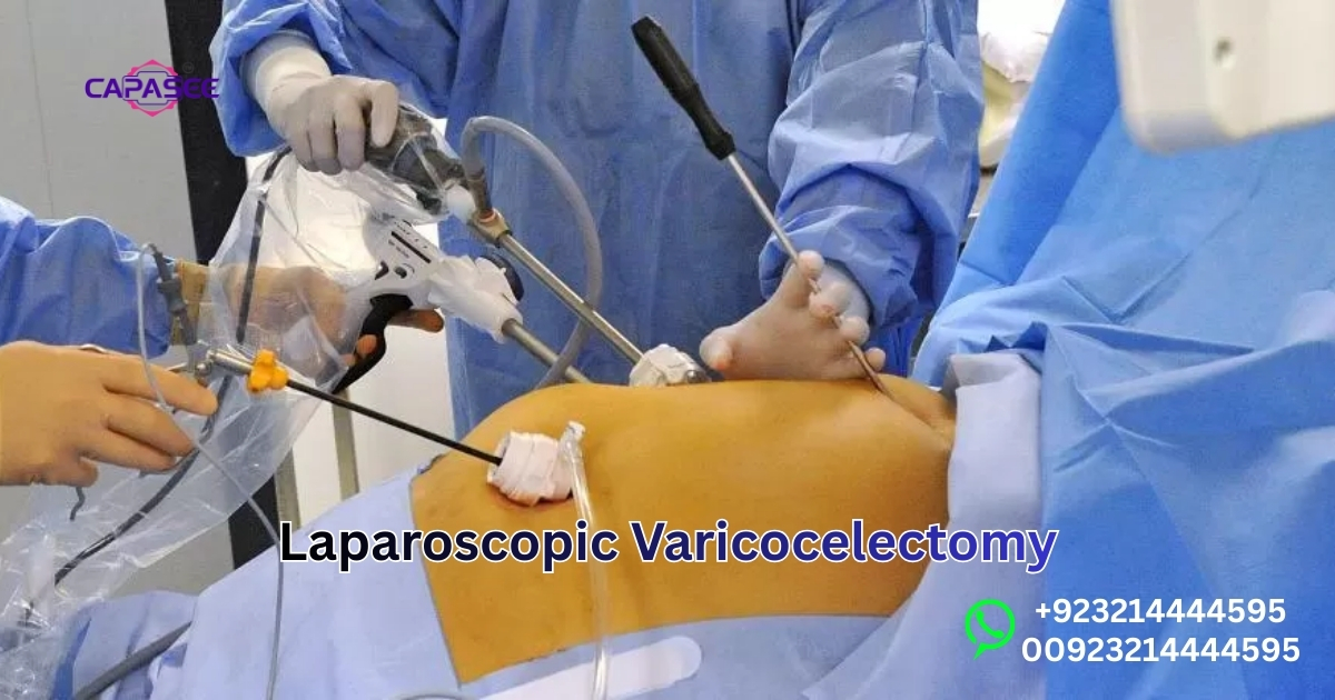 Laparoscopic Varicocelectomy