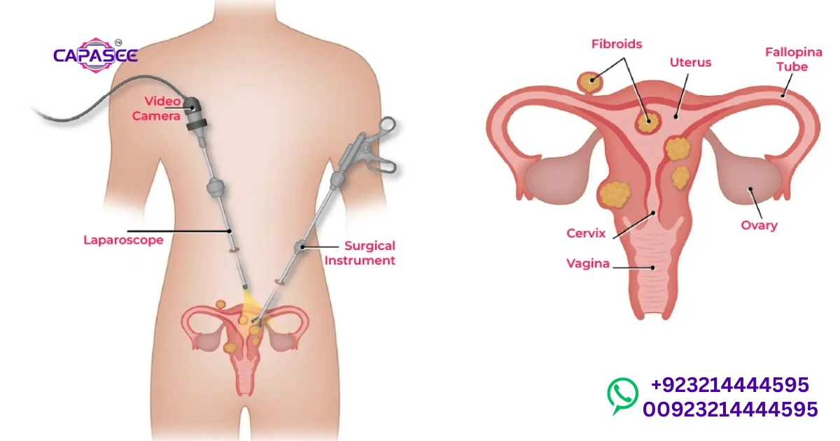Laparoscopic vs Open Myomectomy