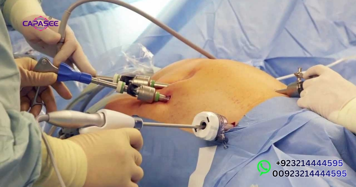 Laparoscopic Cholecystectomy Cost in Pakistan