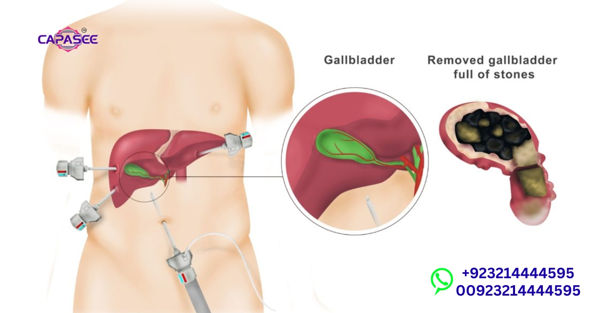 Laparoscopic Kidney Stone Removal in Pakistan