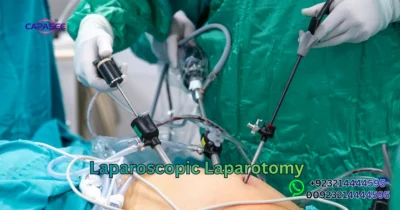 Laparoscopic Laparotomy