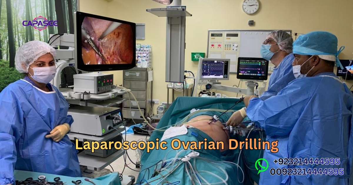 Laparoscopic Ovarian Drilling