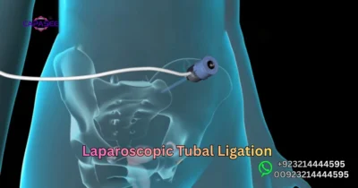 Laparoscopic Tubal Ligation