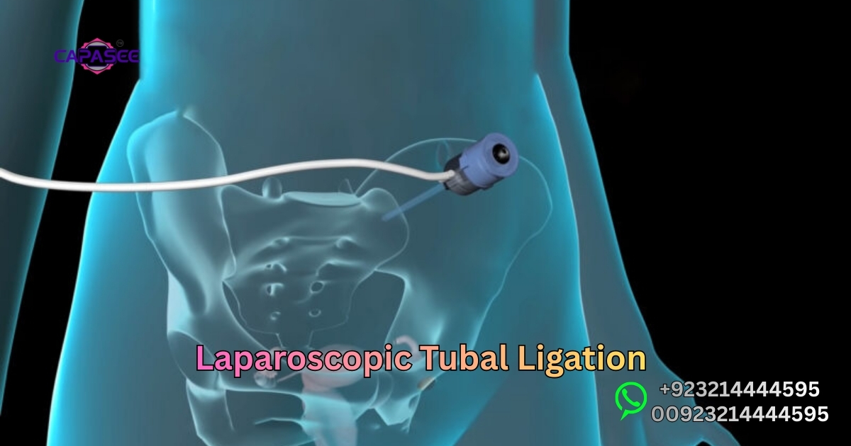 Laparoscopic Tubal Ligation