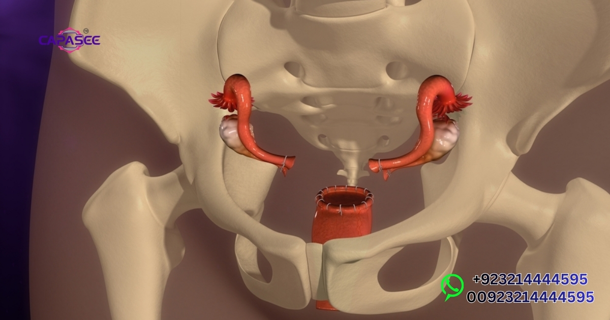 Ovarian Drilling Success Rate in Pakistan